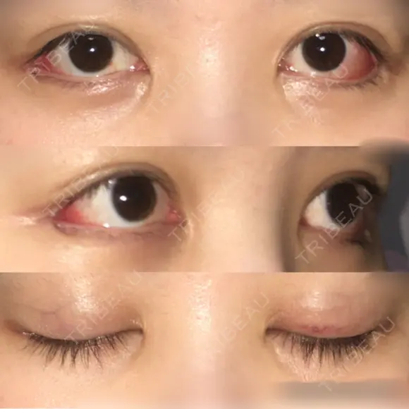 目尻切開 / 目尻靭帯移動 FROM B整形外科 (旧バウム整形外科) DAY 10 メイン用