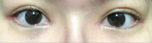 目頭切開 / 眼瞼下垂（切開） / 目尻切開 / 上まぶたの脂肪取り / タレ目形成・グラマラスライン（切開） BIANCA銀座 DAY 28 メイン用