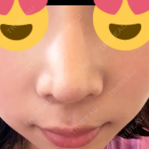 鼻尖形成（切開） / ヒアルロン酸注入（鼻） 東京ヒルズクリニック 岡崎院 DAY 7 メイン用