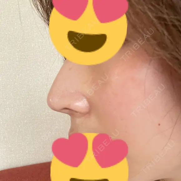 鼻尖形成（切開） / ヒアルロン酸注入（鼻） 東京ヒルズクリニック 岡崎院 DAY 7 メイン用