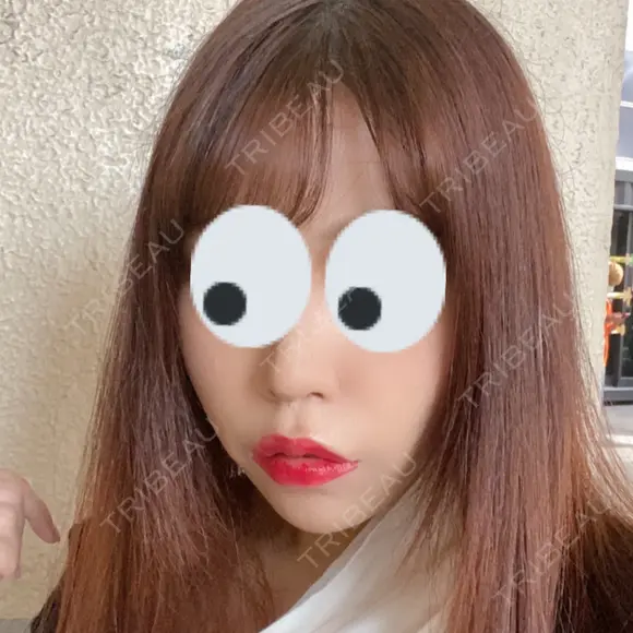 脂肪吸引（顔） ルラ美容クリニック 渋谷本院 DAY 28 メイン用