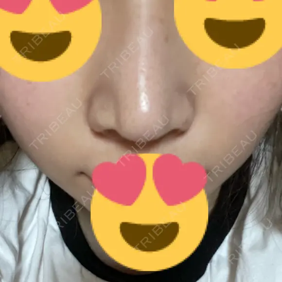 鼻尖形成（切開） / ヒアルロン酸注入（鼻） 東京ヒルズクリニック 岡崎院 DAY 8 メイン用