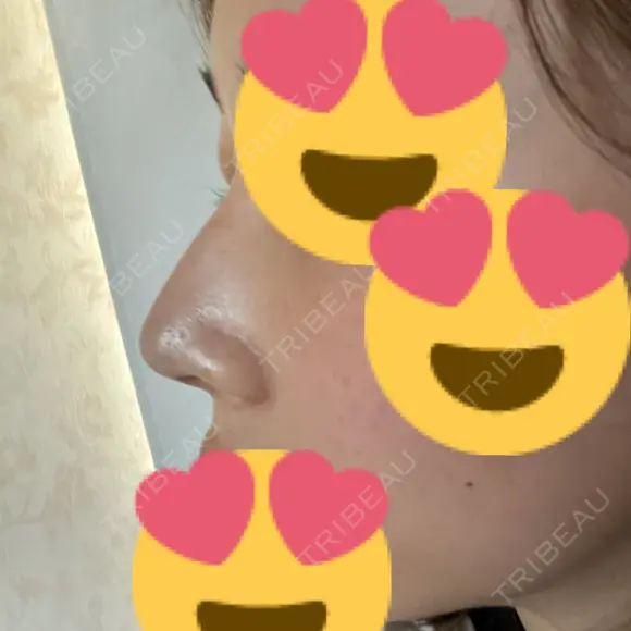 鼻尖形成（切開） / ヒアルロン酸注入（鼻） 東京ヒルズクリニック 岡崎院 DAY 8 メイン用