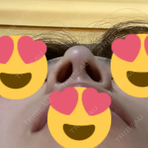 鼻尖形成（切開） / ヒアルロン酸注入（鼻） 東京ヒルズクリニック 岡崎院 DAY 8 メイン用