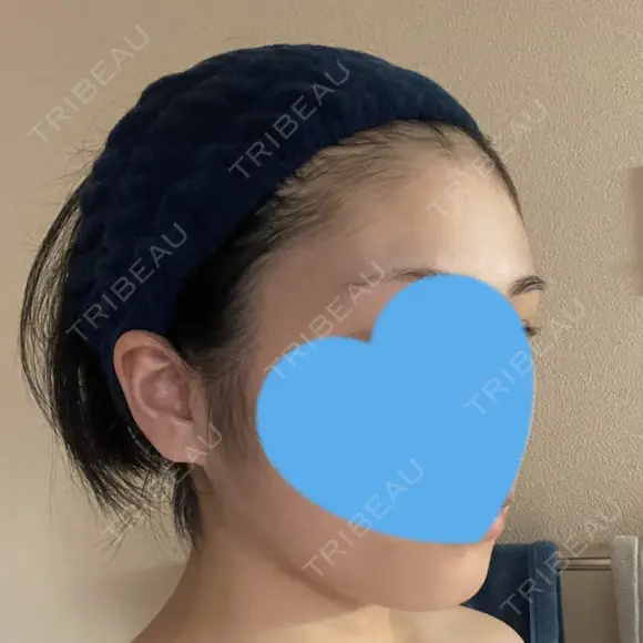 糸リフト / 脂肪吸引（顔） 銀座マイアミ美容外科 DAY 152 メイン用