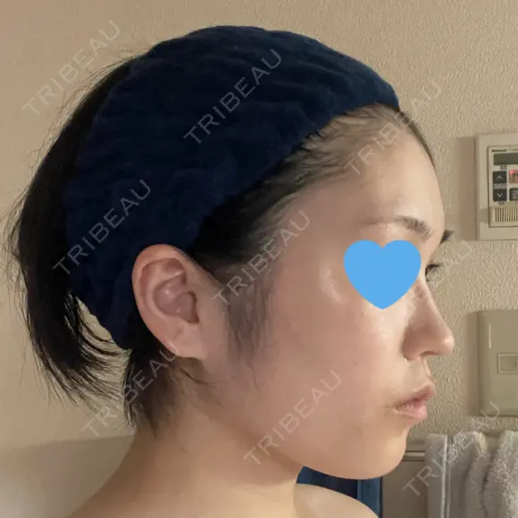 糸リフト / 脂肪吸引（顔） 銀座マイアミ美容外科 DAY 152 メイン用