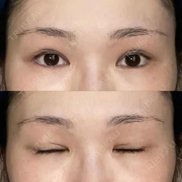 二重切開 / 目頭切開 / 眼瞼下垂（切開） / 上まぶたの脂肪取り 銀座マイアミ美容外科 DAY 153 メイン用