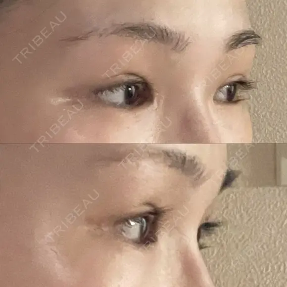 二重切開 / 目頭切開 / 眼瞼下垂（切開） / 上まぶたの脂肪取り 銀座マイアミ美容外科 DAY 153 メイン用