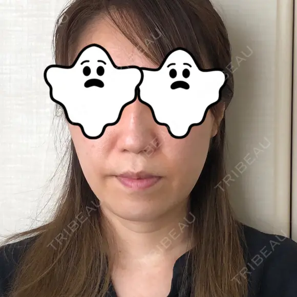 ハイフ（顔） 藤・ナチュレ美容クリニック 恵比寿院 DAY 7 メイン用