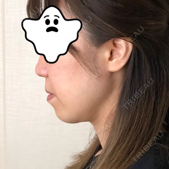 ハイフ（顔） 藤・ナチュレ美容クリニック 恵比寿院 DAY 7 メイン用