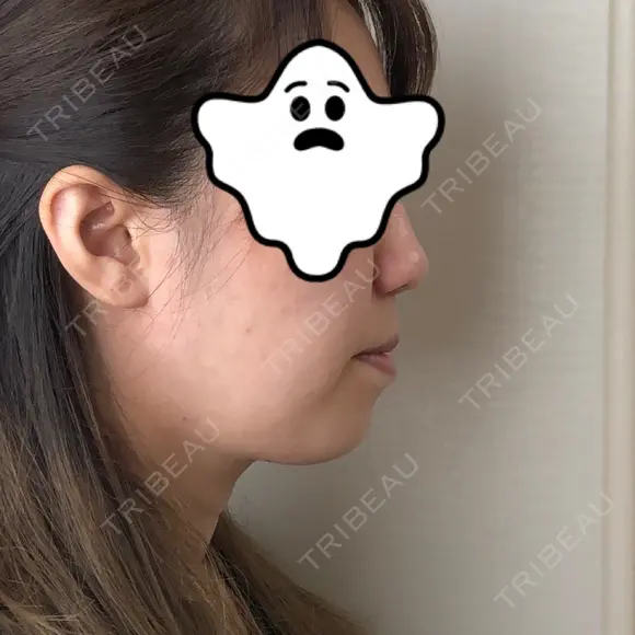 ハイフ（顔） 藤・ナチュレ美容クリニック 恵比寿院 DAY 7 メイン用