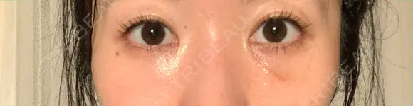 クマ治療 / 下まぶたの脂肪取り 湘南美容クリニック 赤羽院 DAY 12 メイン用