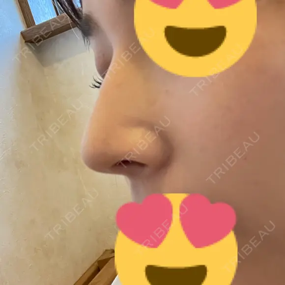 鼻尖形成（切開） / ヒアルロン酸注入（鼻） 東京ヒルズクリニック 岡崎院 DAY 9 メイン用