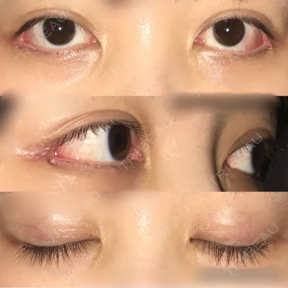 目尻切開 / 目尻靭帯移動 FROM B整形外科 (旧バウム整形外科) DAY 16 メイン用