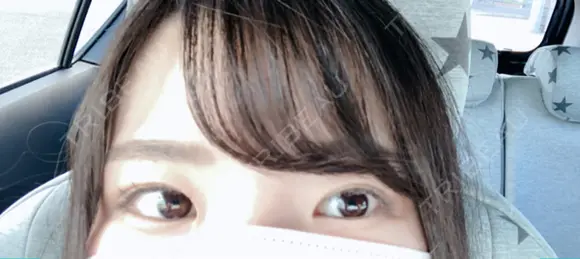 二重切開 松下皮フ形成外科 DAY 67 メイン用