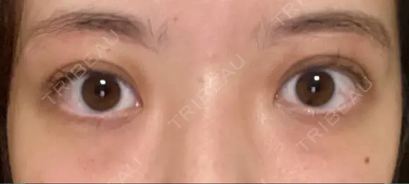 眉下切開 Taide Suenaga Clinic（タイデスエナガクリニック） DAY 197 メイン用