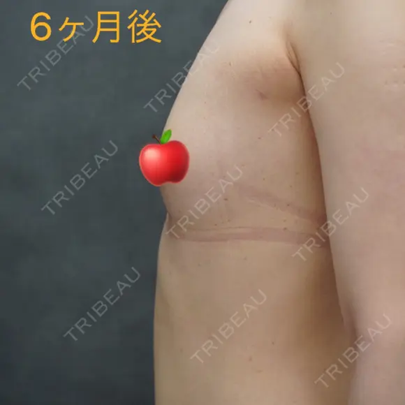 豊胸（脂肪注入） ヴェルトラクリニック 大阪院 DAY 212 メイン用
