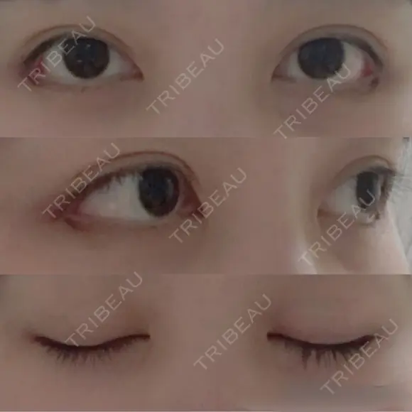 目尻切開 / 目尻靭帯移動 FROM B整形外科 (旧バウム整形外科) DAY 20 メイン用