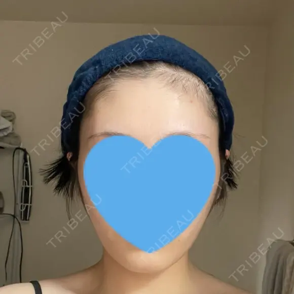 糸リフト / 脂肪吸引（顔） 銀座マイアミ美容外科 AFTER メイン用