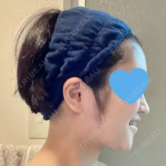 糸リフト / 脂肪吸引（顔） 銀座マイアミ美容外科 DAY 181 メイン用