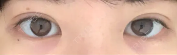 二重切開 松下皮フ形成外科 DAY 13 メイン用