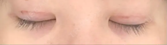 二重切開 松下皮フ形成外科 DAY 13 メイン用