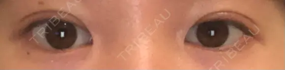 二重切開 松下皮フ形成外科 DAY 13 メイン用