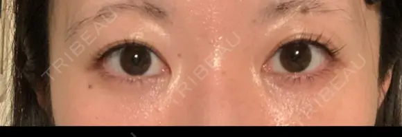 クマ治療 / 下まぶたの脂肪取り 湘南美容クリニック 赤羽院 DAY 21 メイン用