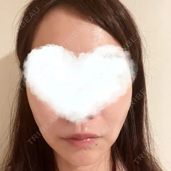 糸リフト 湘南美容クリニック 岡山院 DAY 8 メイン用