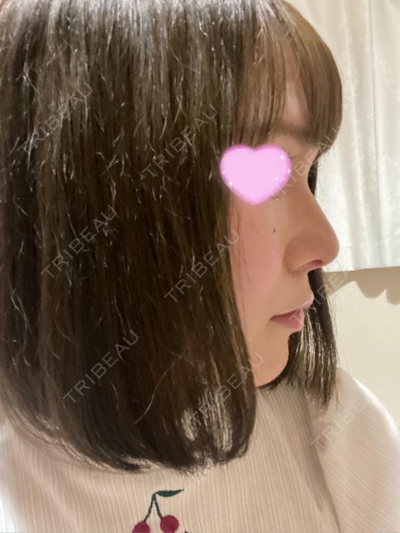 鼻中隔延長（切開） / 軟骨移植 / 眉間プロテーゼ ビスポーククリニック 福岡院 AFTER メイン用