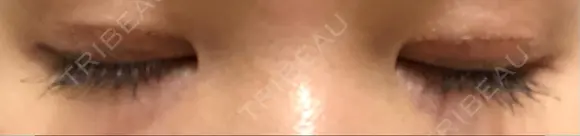 二重切開 松下皮フ形成外科 DAY 14 メイン用