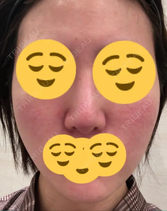 ほくろ・いぼ切除（肌） / その他（肌） / 美肌レーザー / シミ取りレーザー / 美白レーザー クロスクリニック銀座 DAY 41 メイン用