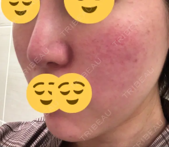 ほくろ・いぼ切除（肌） / その他（肌） / 美肌レーザー / シミ取りレーザー / 美白レーザー クロスクリニック銀座 DAY 41 メイン用