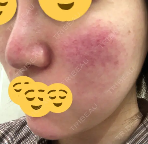 ほくろ・いぼ切除（肌） / その他（肌） / 美肌レーザー / シミ取りレーザー / 美白レーザー クロスクリニック銀座 DAY 41 メイン用