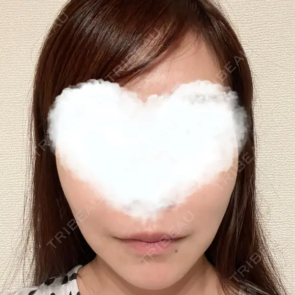 糸リフト 湘南美容クリニック 岡山院 DAY 10 メイン用