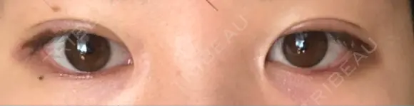 二重切開 松下皮フ形成外科 DAY 17 メイン用