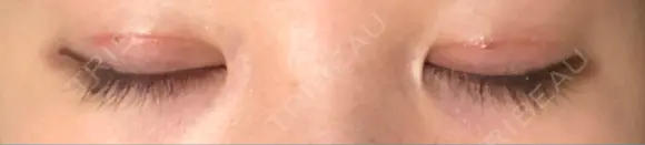 二重切開 松下皮フ形成外科 DAY 17 メイン用