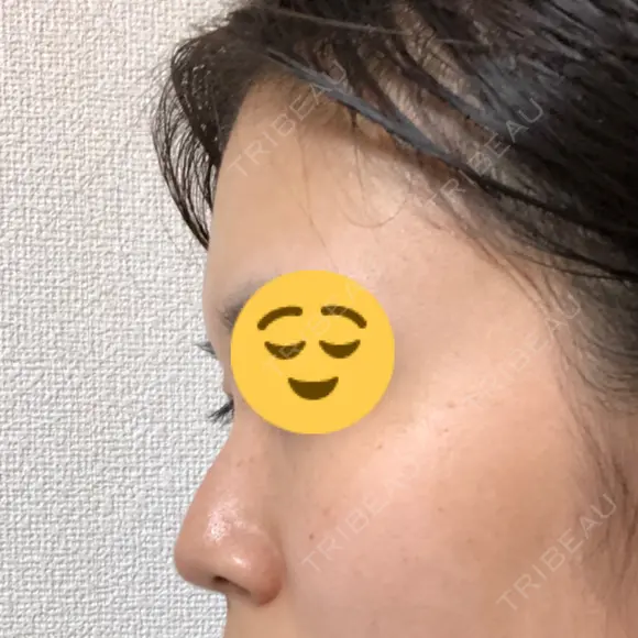 軟骨移植 フェアクリニック川口 DAY 44 メイン用