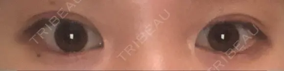 二重切開 松下皮フ形成外科 AFTER メイン用