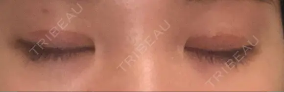 二重切開 松下皮フ形成外科 DAY 17 メイン用