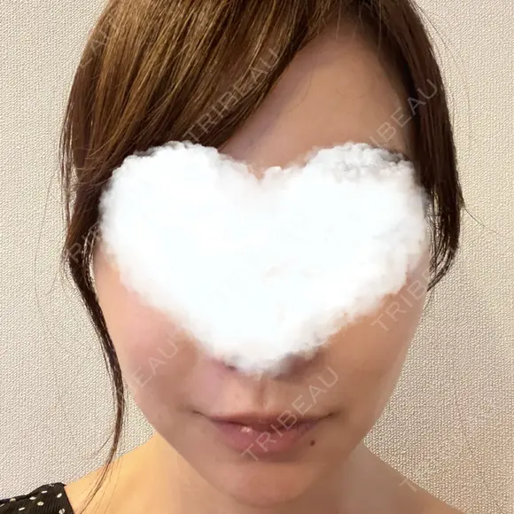 糸リフト 湘南美容クリニック 岡山院 AFTER メイン用