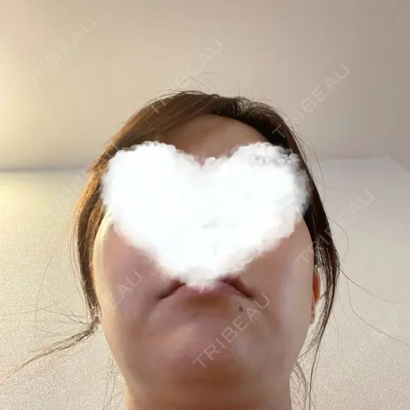 糸リフト 湘南美容クリニック 岡山院 DAY 12 メイン用