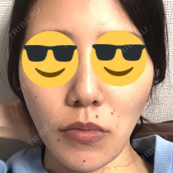 骨切り（あご） / 脂肪吸引（顔） 銀座マイアミ美容外科 DAY 111 メイン用