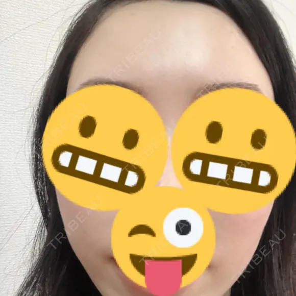 脂肪注入（額） 牧野美容クリニック DAY 25 メイン用
