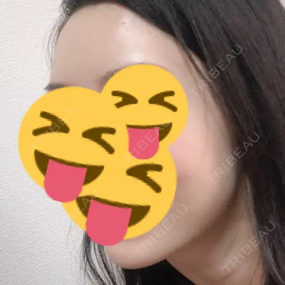 脂肪注入（額） 牧野美容クリニック DAY 25 メイン用