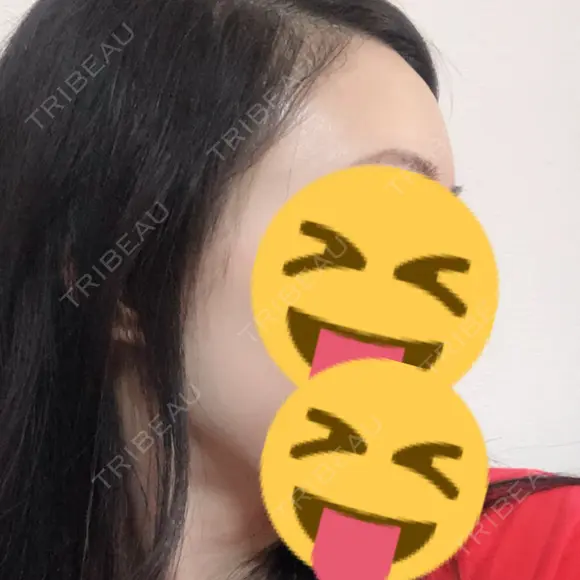 脂肪注入（額） 牧野美容クリニック DAY 25 メイン用