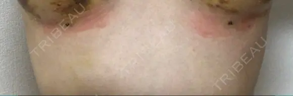 脂肪吸引（お腹） / 脂肪吸引（お尻） / 豊胸（脂肪注入） / その他（ボディ） ドクターフィット（Dr.fit）クリニック DAY 10 メイン用