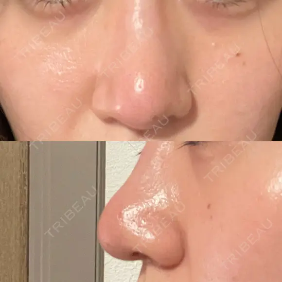 鼻尖形成（切開） / 鼻尖縮小 / その他（鼻） 聖心美容クリニック 札幌院 DAY 10 メイン用