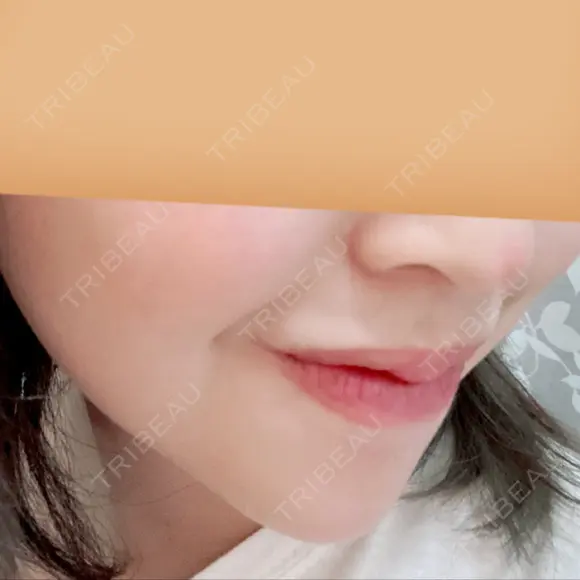 あごプロテーゼ 北尾クリニック DAY 91 メイン用