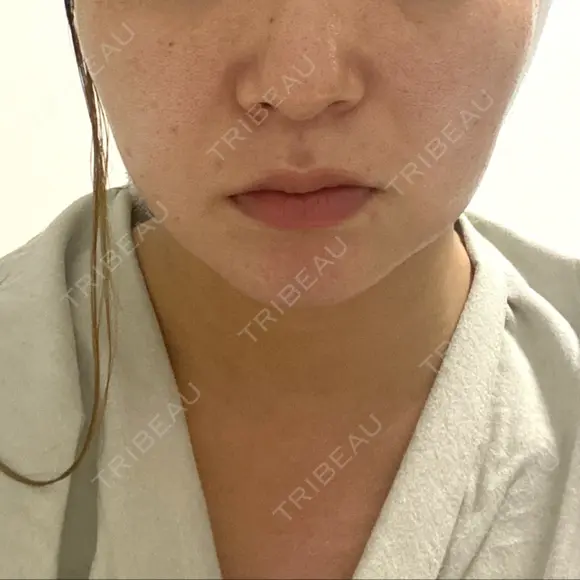 糸リフト 表参道スキンクリニック 表参道院 AFTER メイン用